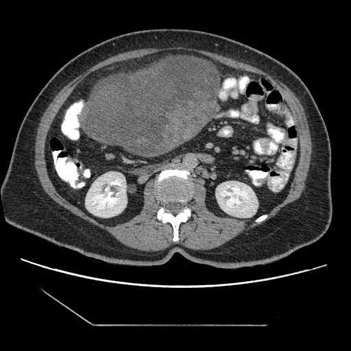 File:Atypical retroperitoneal lymphocoeles with large leiomyoma of uterus (Radiopaedia 32084-33024 A 19).jpg