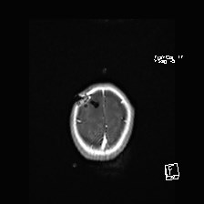 Atypical teratoid rhabdoid tumor (prenatal US and neonatal MRI) (Radiopaedia 59091-66388 Axial T1 C+ 54).jpg
