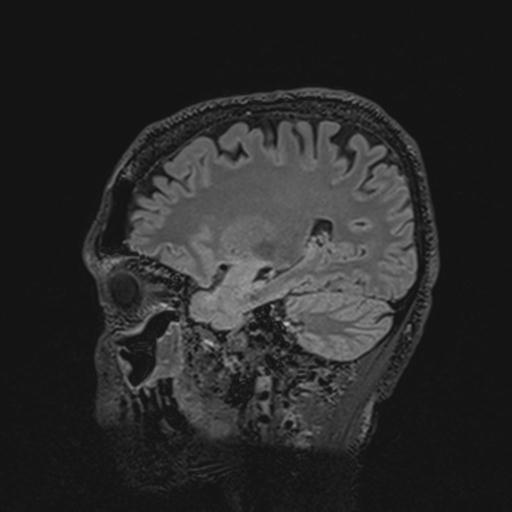 Autoimmune limbic encephalitis (Radiopaedia 30363-31005 Sagittal FLAIR 56).jpg