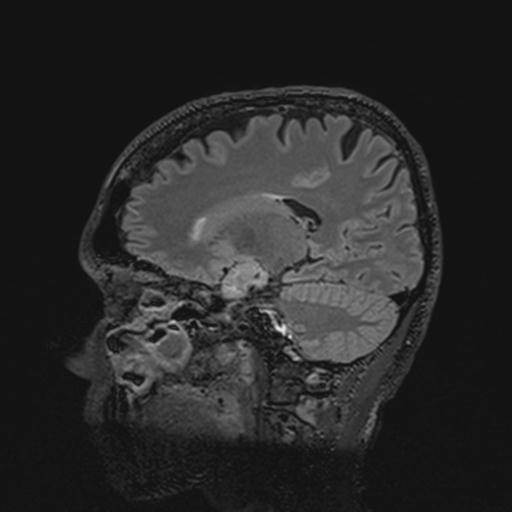 Autoimmune limbic encephalitis (Radiopaedia 30363-31005 Sagittal FLAIR 64).jpg