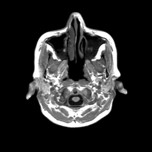Autoimmune limbic encephalitis (Radiopaedia 30363-31005 T1 Axial 3mm 4).jpg