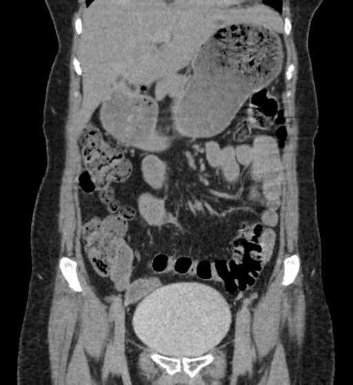 Autosomal dominant polycystic kidney disease (Radiopaedia 38189-40194 Coronal C+ delayed 21).jpg