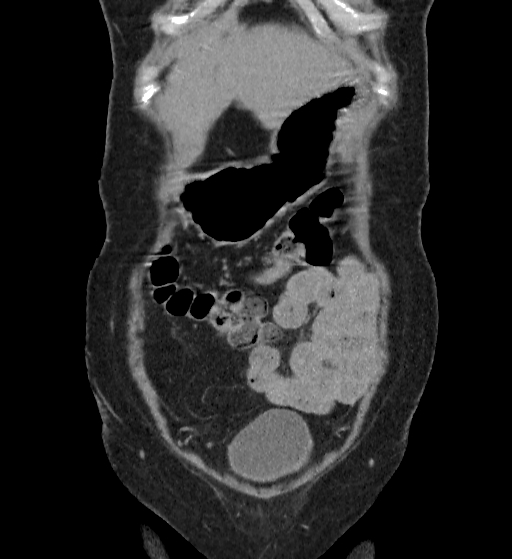 Autosomal dominant polycystic kidney disease (Radiopaedia 38189-40194 Coronal C+ delayed 3).jpg