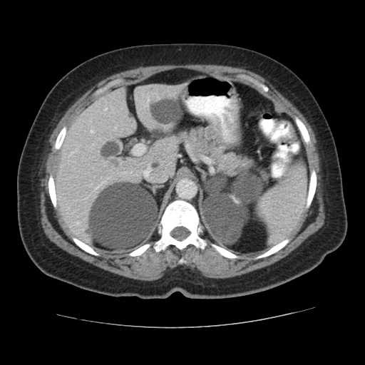 File:Autosomal dominant polycystic kidney disease with hepatic involvement (Radiopaedia 32693-33662 B 20).jpg