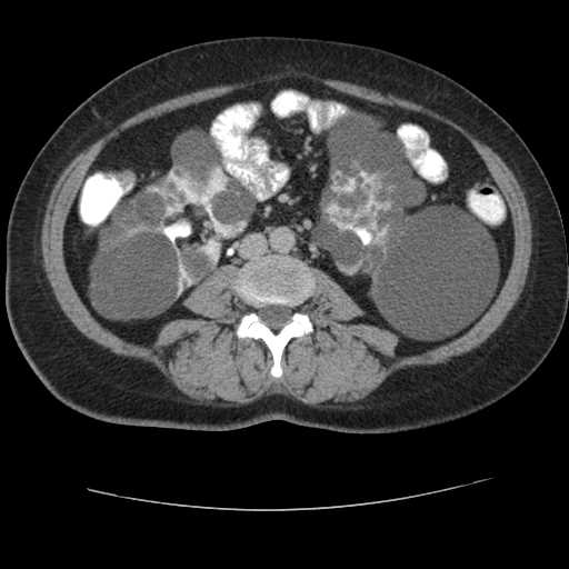 Autosomal dominant polycystic kidney disease with hepatic involvement (Radiopaedia 32693-33662 C 45).jpg