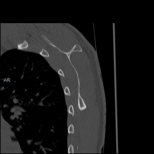Avascular necrosis after fracture dislocations of the proximal humerus (Radiopaedia 88078-104653 Sagittal bone window 67).jpg