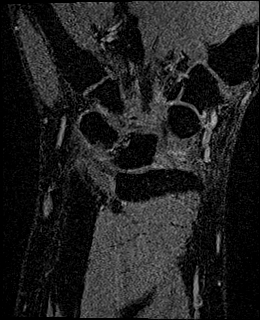 Avascular necrosis of the capitate (Radiopaedia 88317-104948 Coronal T1 vibe 50).jpg