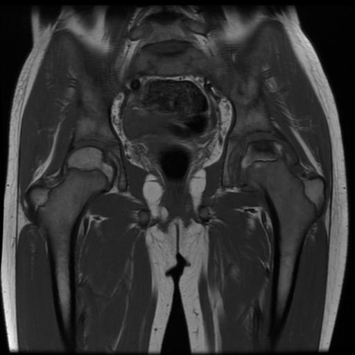 File:Avascular necrosis of the hip (Radiopaedia 29563-30067 Coronal T1 9).jpg