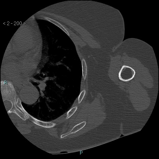 Avascular necrosis of the shoulder - Cruess stage I (Radiopaedia 77674-89887 Axial bone window 50).jpg