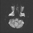 Balo concentric sclerosis (Radiopaedia 50458-55940 Axial DWI 41).jpg