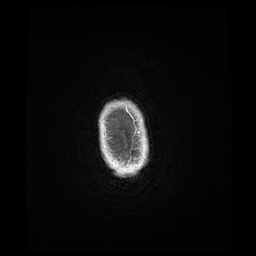 Balo concentric sclerosis (Radiopaedia 53875-59982 Axial LAVA C+ 262).jpg