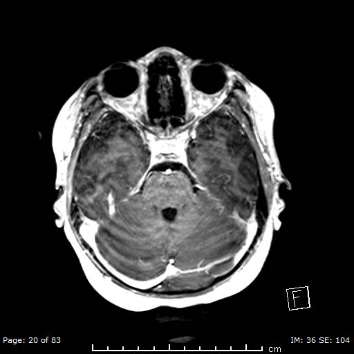 Balo concentric sclerosis (Radiopaedia 61637-69636 Axial T1 C+ 20).jpg