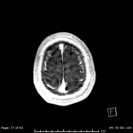 Balo concentric sclerosis (Radiopaedia 61637-69636 Axial T1 C+ 77).jpg