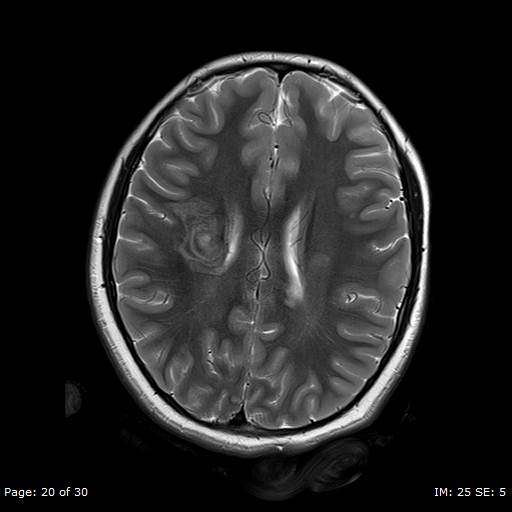 File:Balo concentric sclerosis (Radiopaedia 61637-69636 Axial T2 20).jpg