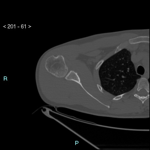 Bankart lesion with glenoid bone defect - assessment TC with PICO method (Radiopaedia 42855-93901 Axial bone window 60).jpg