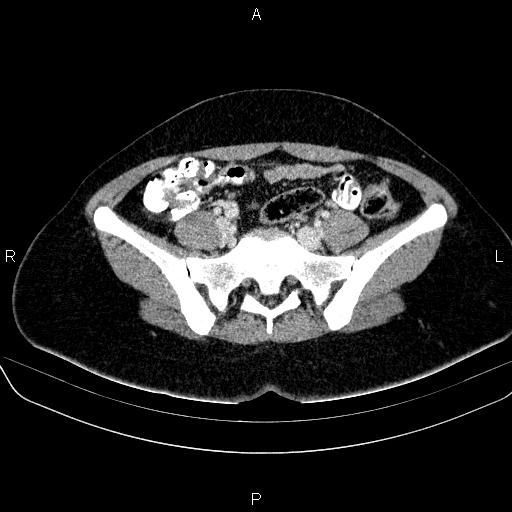 File:Bartholin gland cyst (Radiopaedia 62635-70930 Axial Post contrast 19).jpg