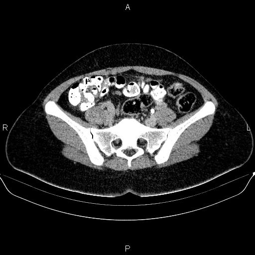 Bartholin gland cyst (Radiopaedia 62635-70930 C 22).jpg