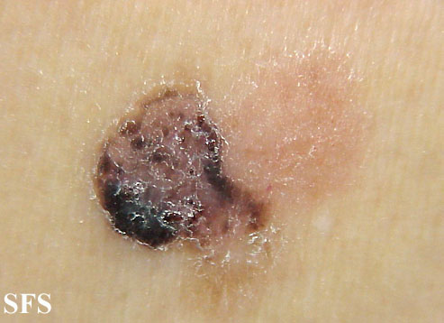 Basal Cell Carcinoma (Dermatology Atlas 78).jpg