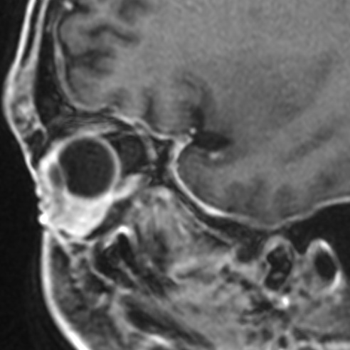 File:Basal cell carcinoma (periorbital) (Radiopaedia 55179-61559 F 9).jpg