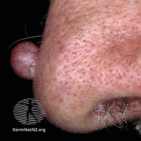 File:Basal cell carcinoma affecting the nose (DermNet NZ lesions-bcc-nose-0628).jpg
