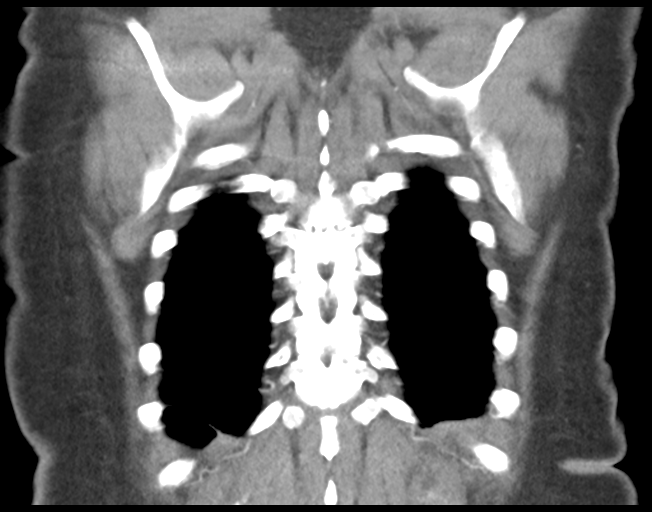 Basal ganglia metastasis (Radiopaedia 78928-91832 C 44).png