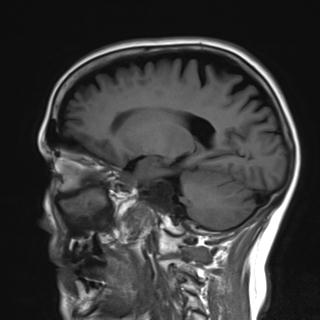 File:Base of skull chondrosarcoma (Radiopaedia 30410-31070 Sagittal T1 7).jpg