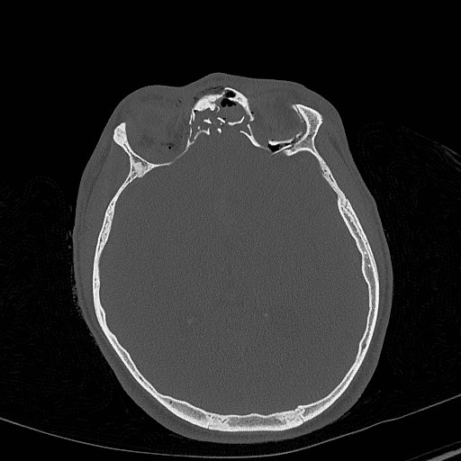 Base of skull fracture with bilateral Le Fort fractures (Radiopaedia 47094-51638 Axial bone window 49).jpg