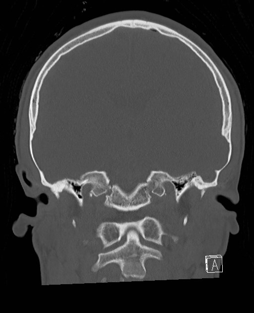 Base of skull fracture with bilateral Le Fort fractures (Radiopaedia 47094-51638 Coronal bone window 46).jpg