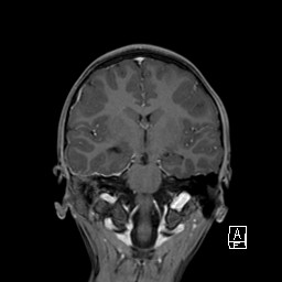 Base of skull rhabdomyosarcoma (Radiopaedia 32196-33142 I 40).jpg