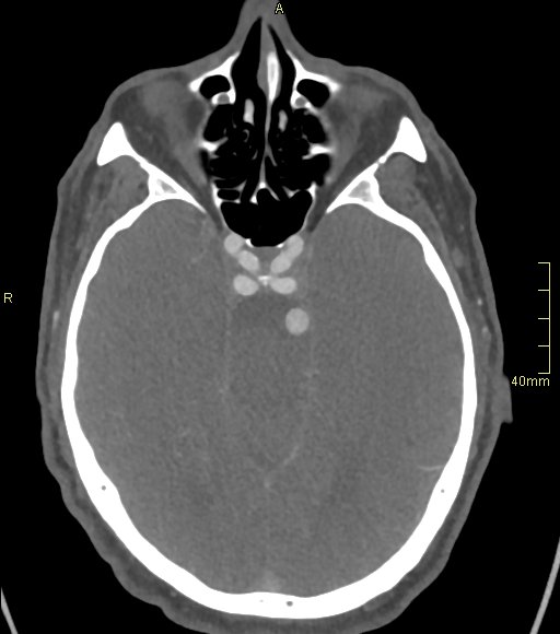 File:Basilar artery aneurysm (Radiopaedia 56261-62932 A 67).jpg