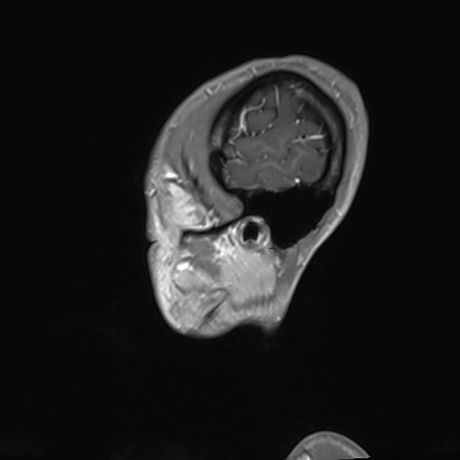 File:Basilar artery perforator aneurysm (Radiopaedia 82455-97733 G 134).jpg