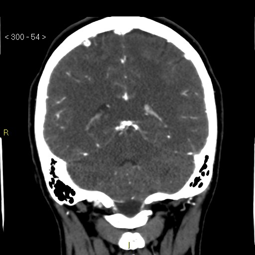 File:Basilar artery thrombosis (Radiopaedia 16260-15944 B 45).jpg