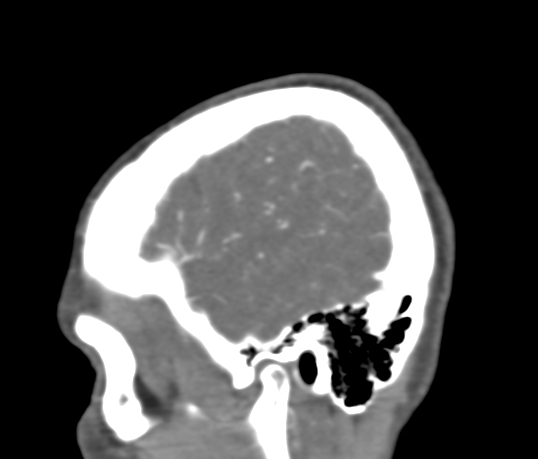 Basilar tip aneurysm with coiling (Radiopaedia 53912-60086 C 12).jpg