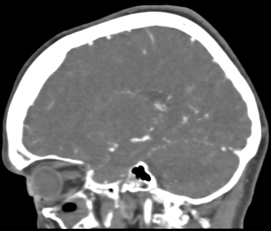 Basilar tip aneurysm with coiling (Radiopaedia 53912-60086 C 87).jpg
