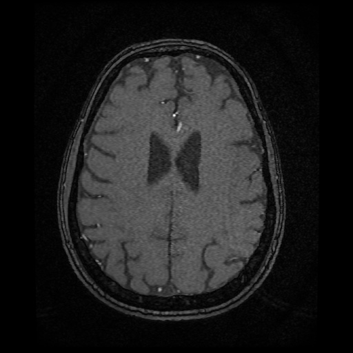 Basilar top and left middle cerebral artery aneurysm (Radiopaedia 61965-70031 Axial MRA 117).jpg