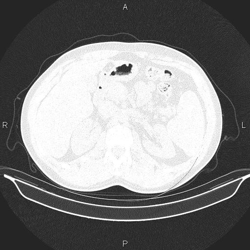 Beam hardening and ring artifacts (Radiopaedia 85323-100915 Axial lung window 79).jpg