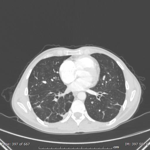 Behçet disease (Radiopaedia 44247-47889 Axial lung window 53).jpg