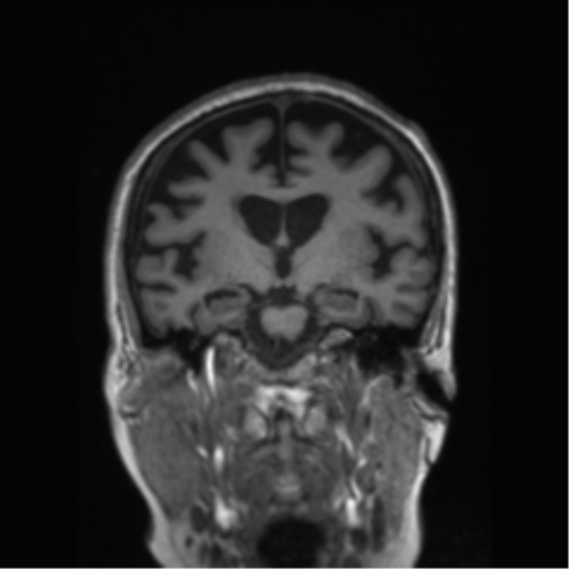 Behavioral variant frontotemporal dementia and late onset schizophrenia (Radiopaedia 52197-58083 Coronal T1 51).png