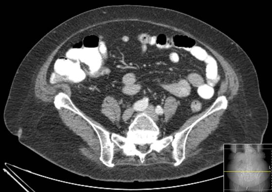 File:Bicameral celiacomesenteric aneurysm (Radiopaedia 55766-62327 A 45).jpg