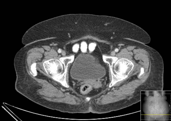 File:Bicameral celiacomesenteric aneurysm (Radiopaedia 55766-62327 A 69).jpg