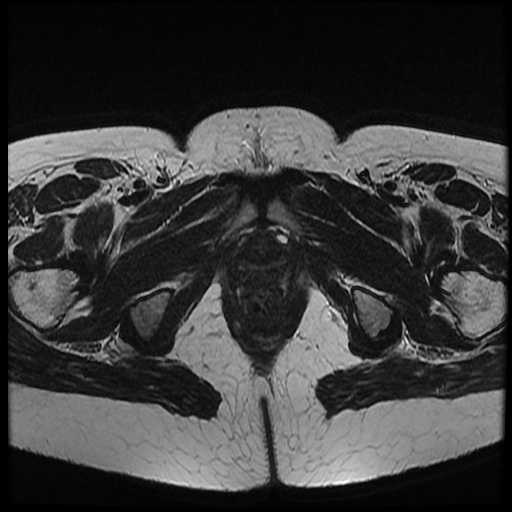 File:Bicornuate uterus (Radiopaedia 51676-57472 Axial T2 7).jpg