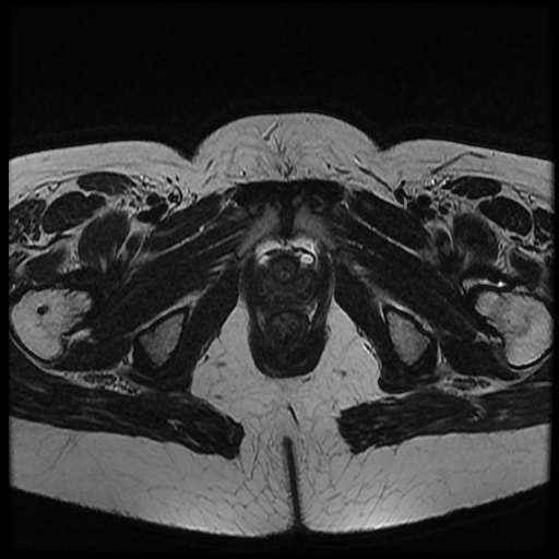 File:Bicornuate uterus (Radiopaedia 51676-57472 Axial T2 8).jpg