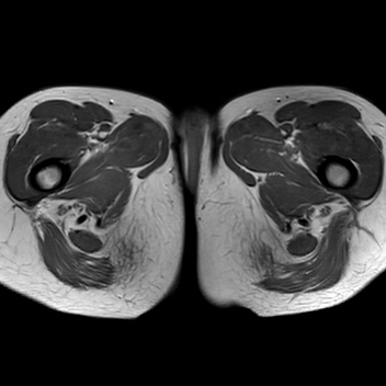 File:Bicornuate uterus (Radiopaedia 61974-70046 Axial T1 48).jpg