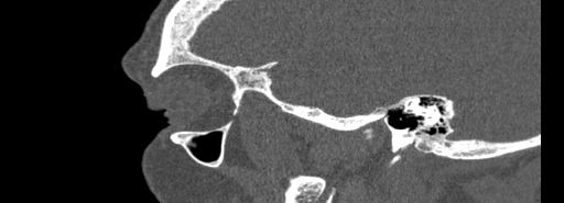 Bilateral Ectopic Infraorbital Nerves (Radiopaedia 49006-54084 Sagittal bone window 50).jpg