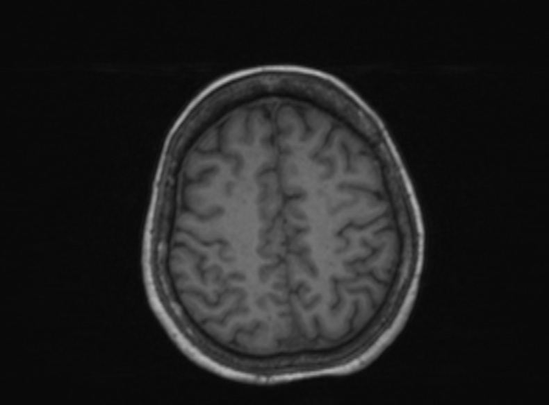File:Bilateral PCA territory infarction - different ages (Radiopaedia 46200-51784 Axial T1 169).jpg