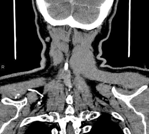 File:Bilateral Warthin tumors (Radiopaedia 84034-99263 C 50).jpg
