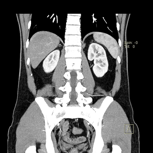 File:Bilateral accessory renal arteries with mild pelvi-ureteric junction (PUJ) obstruction (Radiopaedia 66357-75596 B 42).jpg
