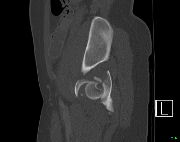 Bilateral acetabular fractures (Radiopaedia 79272-92308 Sagittal bone window 66).jpg