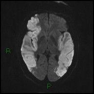 File:Bilateral acute middle cerebral artery territory infarcts (Radiopaedia 77319-89402 Axial DWI 36).jpg