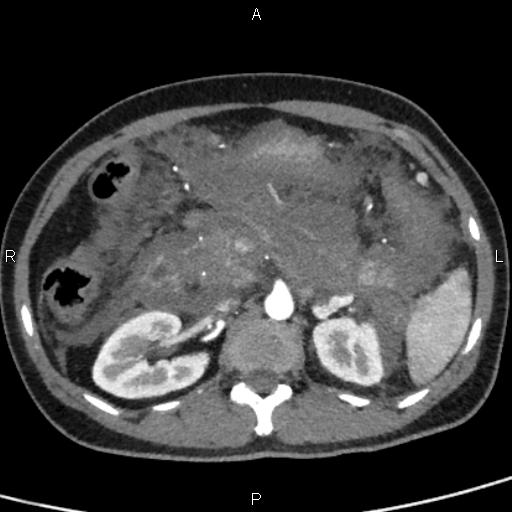 Bilateral adrenal gland hyperenhancement in pancreatitis (Radiopaedia 86642-102753 B 52).jpg